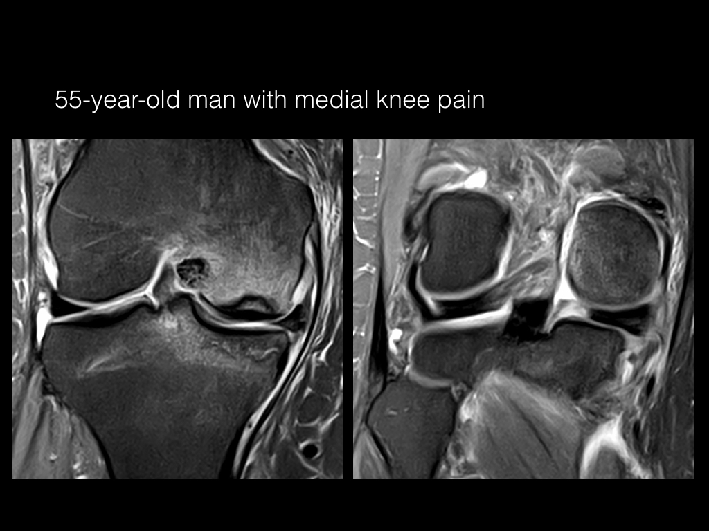 Figure 2 for case stress fracture ( RID4695 ) Osteonecrosis Meniscal Root tear